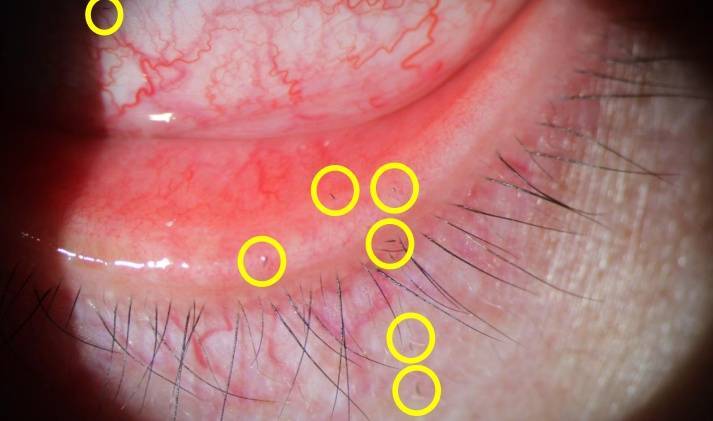 皇冠信用網开户_剧痛！一阵风吹过皇冠信用網开户，女子眼睛被扎进7根“黑刺”……近期多人中招